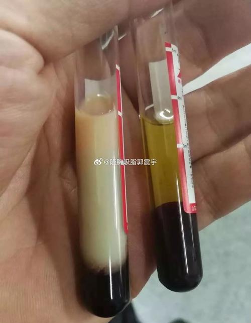 男子体内抽出牛奶血 这样吃饭危害大